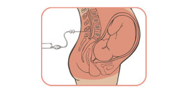 To Drug or Not to Drug? The Epidural Debate