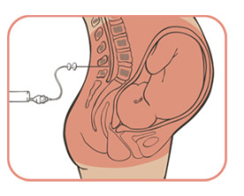 To Drug or Not to Drug? The Epidural Debate