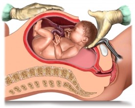 Do C-Sections Impair Maternal Responsiveness?