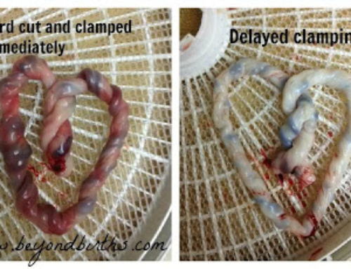 Long-Term Effects of Delayed Cord Clamping Found